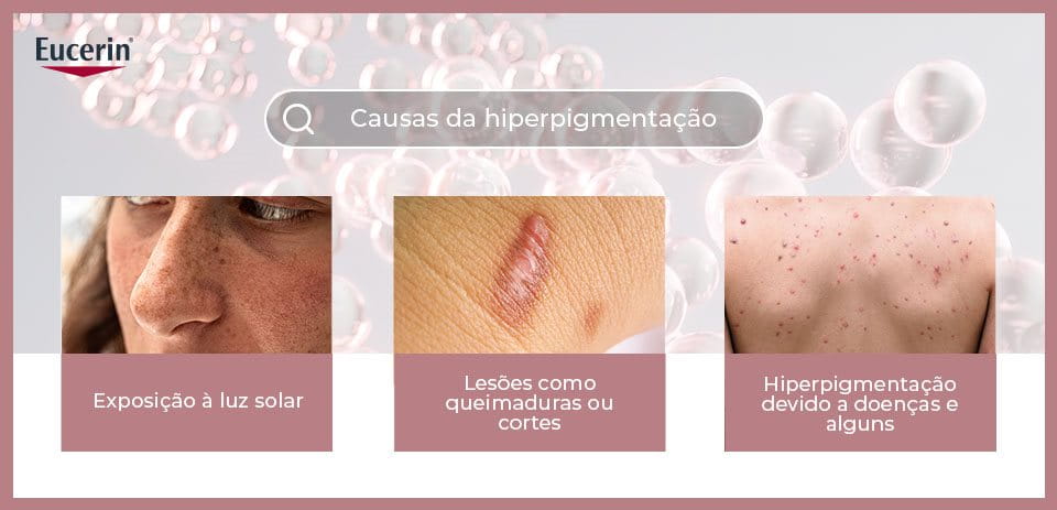 O Que É Hiperpigmentação